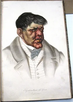 Les Maladies de la Peau 1856 Cazenave Dermatologie 60 platen - 1