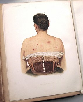 Atlas of Clinical Medicine Vol. 1&2 1892-3 Bramwell Medisch - 1
