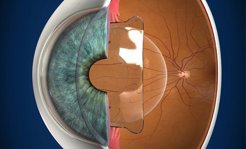 Lensimplantaten - 1