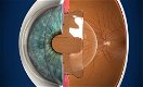 Lensimplantaten - 1 - Thumbnail