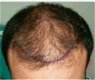 Haartransplantatie methoden - 1 - Thumbnail