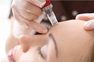 Micro Needling - 1