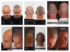 Scalp Pigmentatie