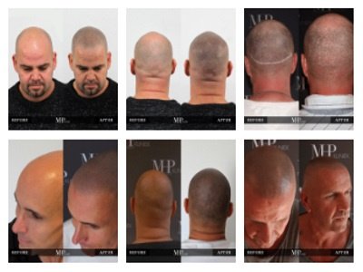 Scalp Pigmentatie - 1