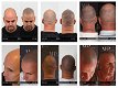 Scalp Pigmentatie - 1 - Thumbnail