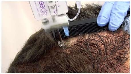 Haaruitval behandeling en Haartransplantatie aanbieding - 2