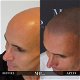 Micro haar pigmentatie of Scalp pigmentatie - 0 - Thumbnail