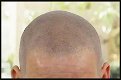 Scalp pigmentatie behandeling? - 0 - Thumbnail