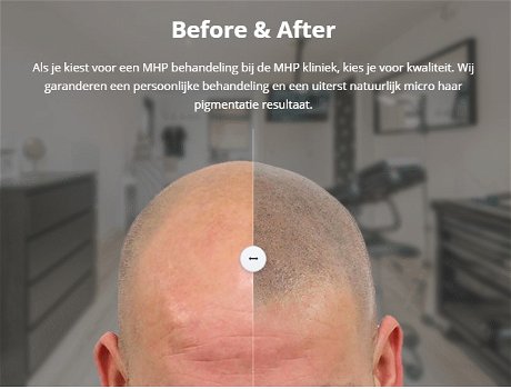 Micro Hair Pigmentation - MHP kliniek - 0