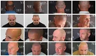 Micro Haar Pigmentatie Kosten - 0 - Thumbnail