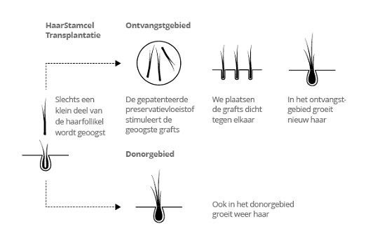 Haartransplantatie in Nederland of buitenland? - 0