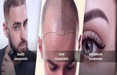 Beste Haartransplantatie Nederland 