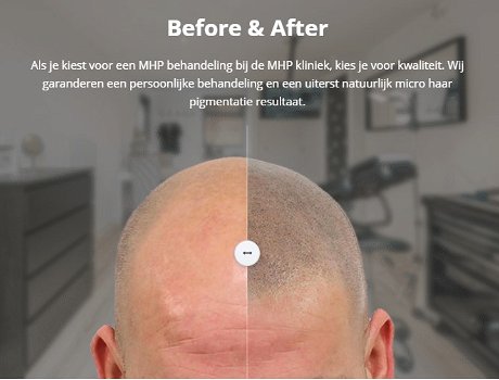 Micro haar pigmentatie litteken - 0