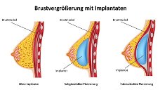 Brustvergrosserung mit Implantaten