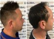 Saffier Techniek Haartransplantatie - 0 - Thumbnail